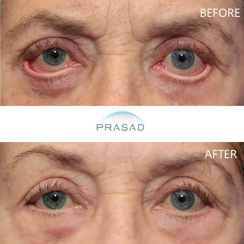 Restoration of rounded lower eyelids on patient who suffered from ectropion and eyelid retraction