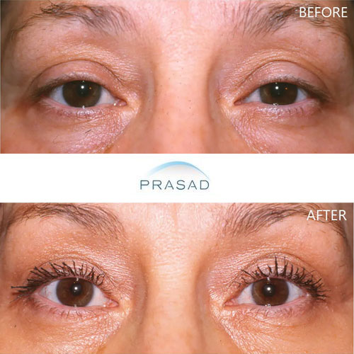 client with misdiagnosed drooping of eyelids corrected by Dr. Amiya Prasad