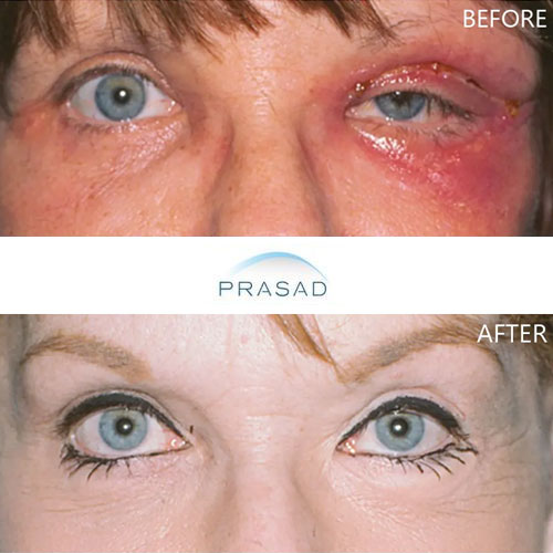 Restoration of upper eyelid skin loss after infection from previous surgery