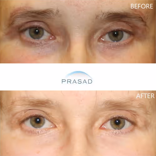 A young male patient after restoration of upper blepharoplasty skin shortage, showing normal eyelid function.