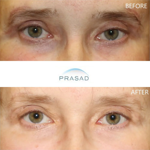 A young male patient after restoration of upper blepharoplasty skin shortage, showing normal eyelid function.