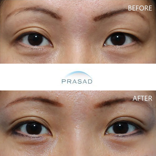 A young Asian woman after revision eyelid surgery, showing improved creases.