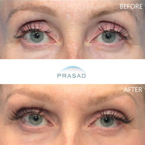 A middle-aged woman with upper eyelid hollowness, improved by Dr. Prasad without additional surgery
