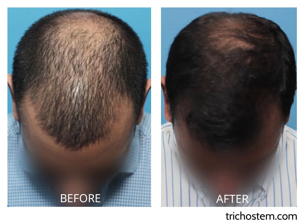 young female showing improved upper and lower eyelids