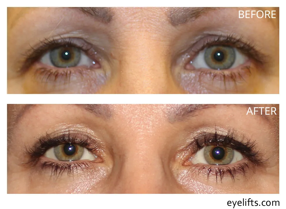 female showing improved lower eyelid after complications