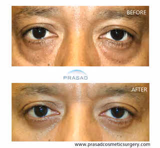 male in 50s with prominent eye bags and the same person without eye bags and scars