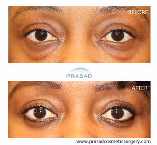 female with African-American heritage showing refreshed young eyes without eye bags