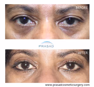 woman in 50s with dark skin showing significantly reduced eye bags