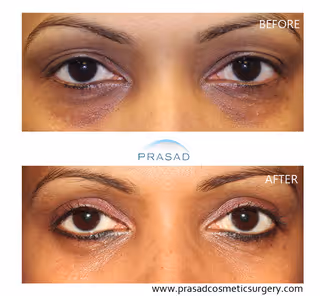 young female showing improved upper and lower eyelids