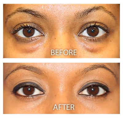 a young female with dark skin showing improved under eyes without eye bags and visible scars