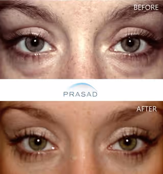 Middle-aged woman with enhanced look after Asian eyelid transformation