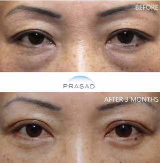Middle-aged woman with enhanced look after Asian eyelid transformation