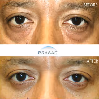 Middle-aged woman with enhanced look after Asian eyelid transformation