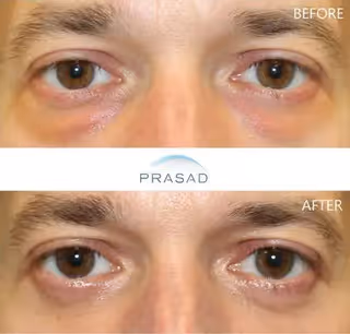 Middle-aged woman with enhanced look after Asian eyelid transformation