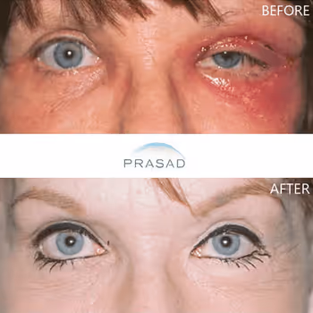 Middle-aged woman with enhanced look after Asian eyelid transformation