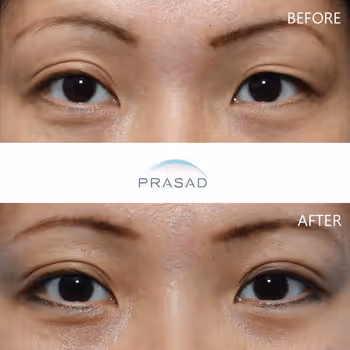 Middle-aged woman with enhanced look after Asian eyelid transformation