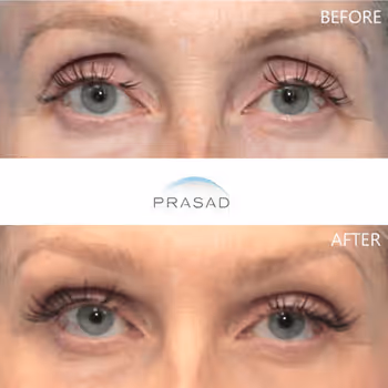 Middle-aged woman with enhanced look after Asian eyelid transformation