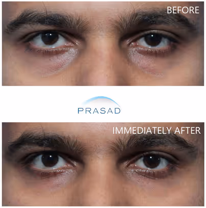 young man showing significantly improved under eyes caused by hollowing