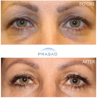Woman in 50s showcasing improved under-eye appearance with reduced discoloration