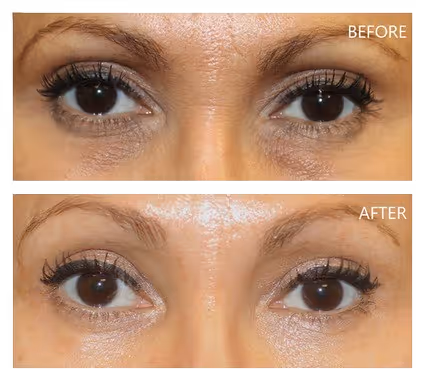 a woman showing improvement of under eyes from dark circles caused by pigmentations