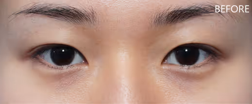 A female with tired looking eyes and obvious under eye bags