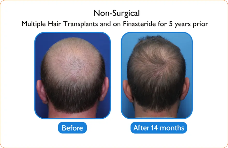 Middle-aged woman with enhanced look after Asian eyelid transformation