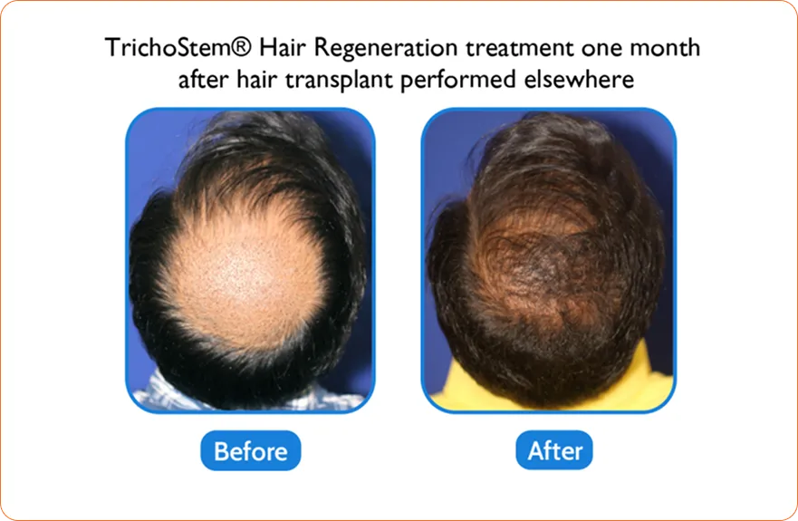 Middle-aged woman with enhanced look after Asian eyelid transformation