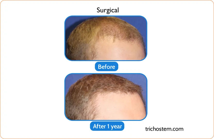 Middle-aged woman with enhanced look after Asian eyelid transformation