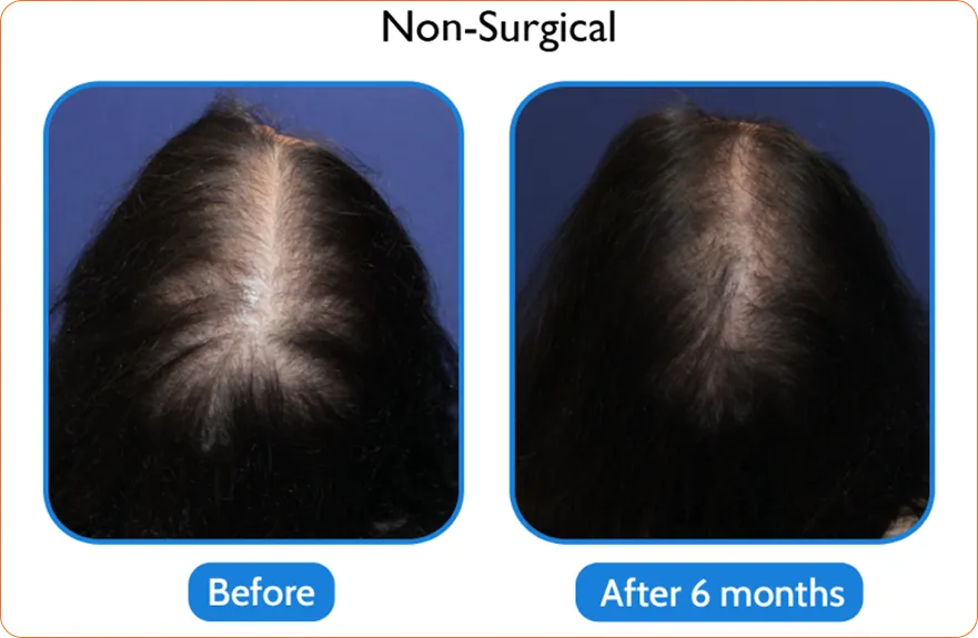 Middle-aged woman with enhanced look after Asian eyelid transformation