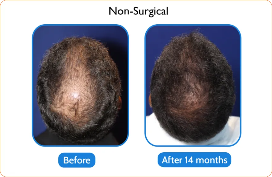 Middle-aged woman with enhanced look after Asian eyelid transformation