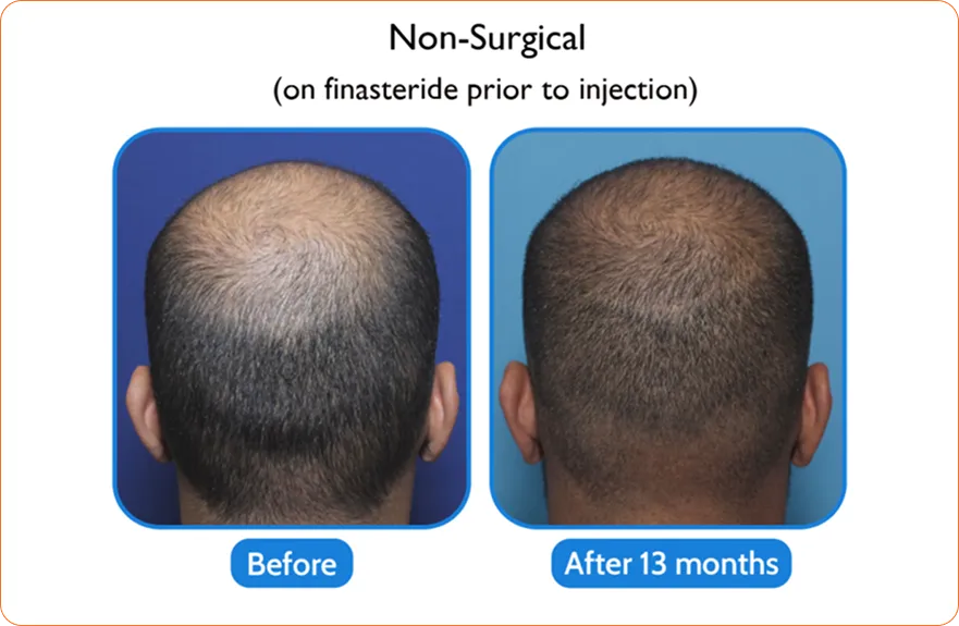 Middle-aged woman with enhanced look after Asian eyelid transformation