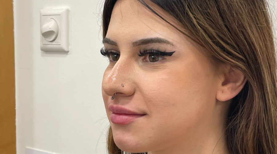 Aumento de labios con ácido hialurónico: resultado