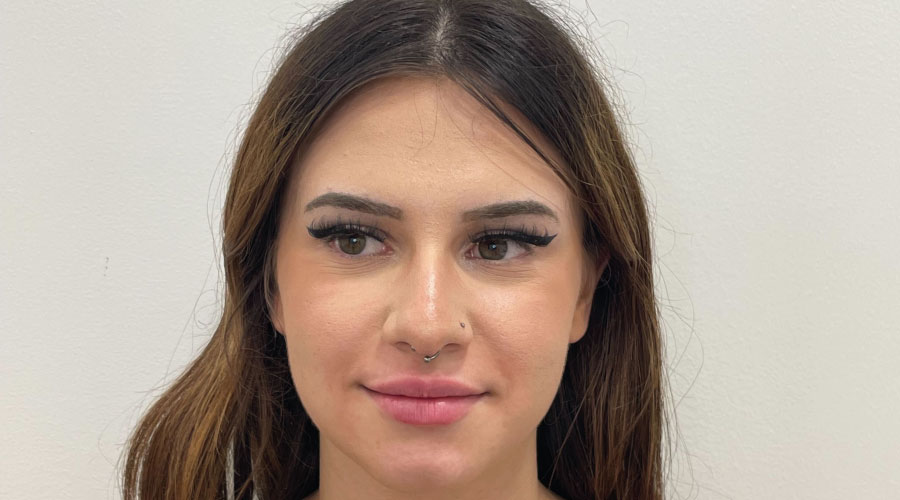 Aumento de labios con ácido hialurónico en Bahamas Clinic