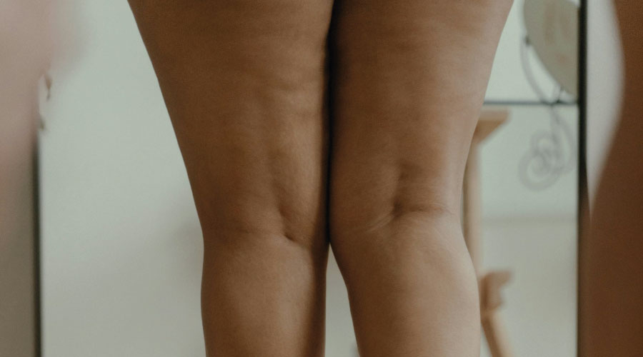 Tratamiento Celuliss para la celulitis en Bahamas Clinic