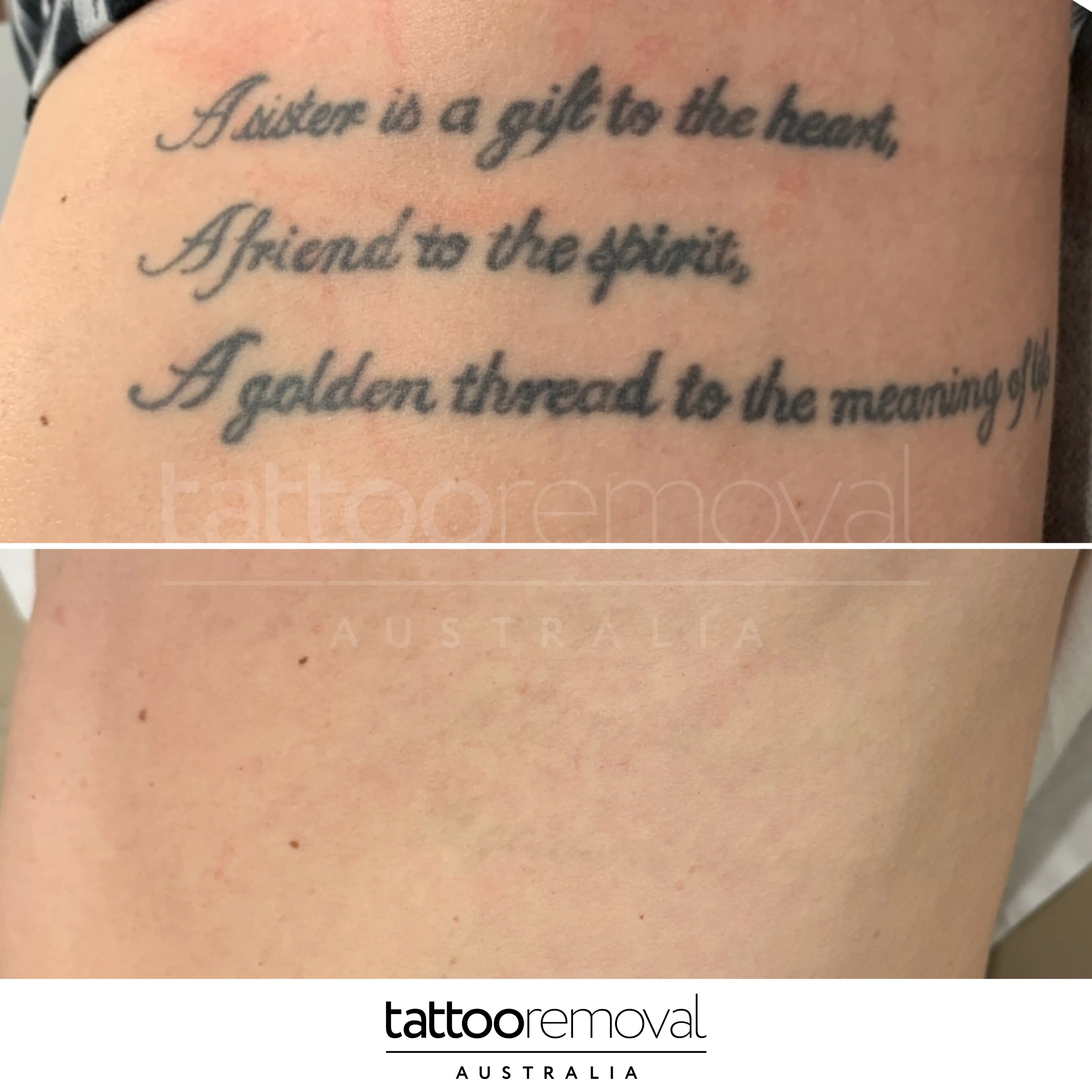 laser tattoo removal expert