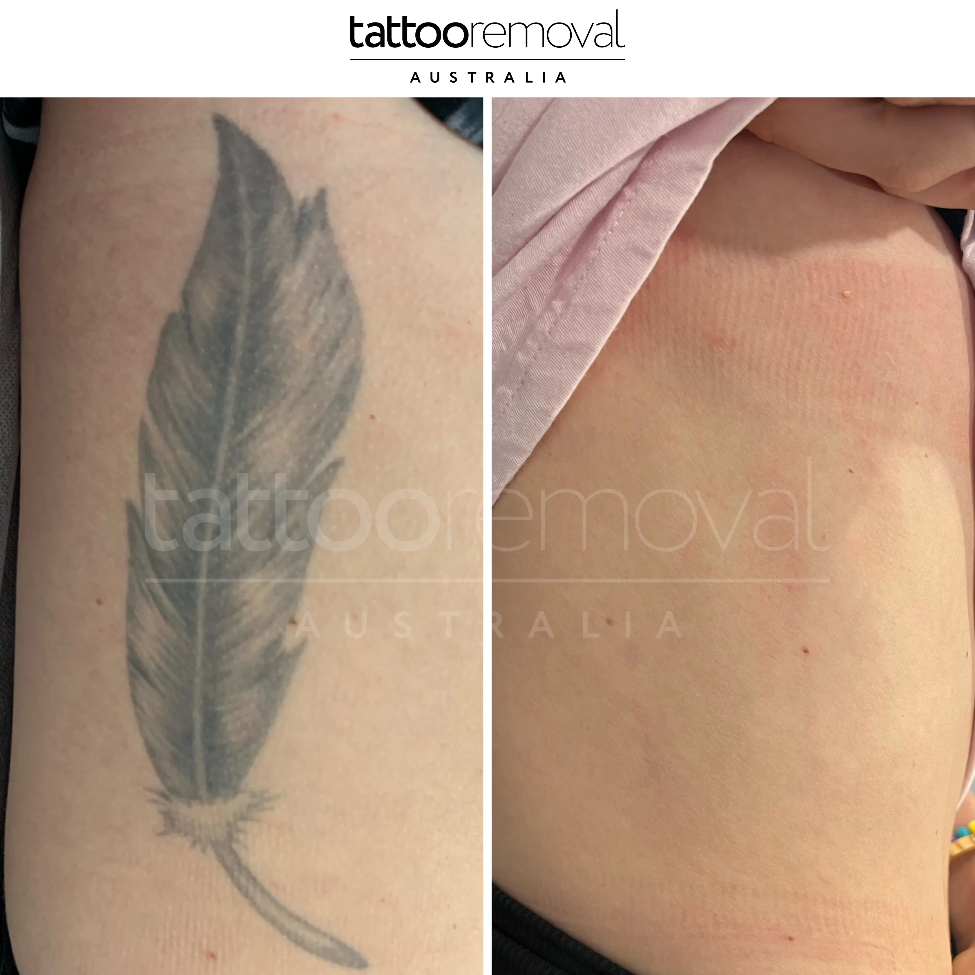 laser tattoo removal expert