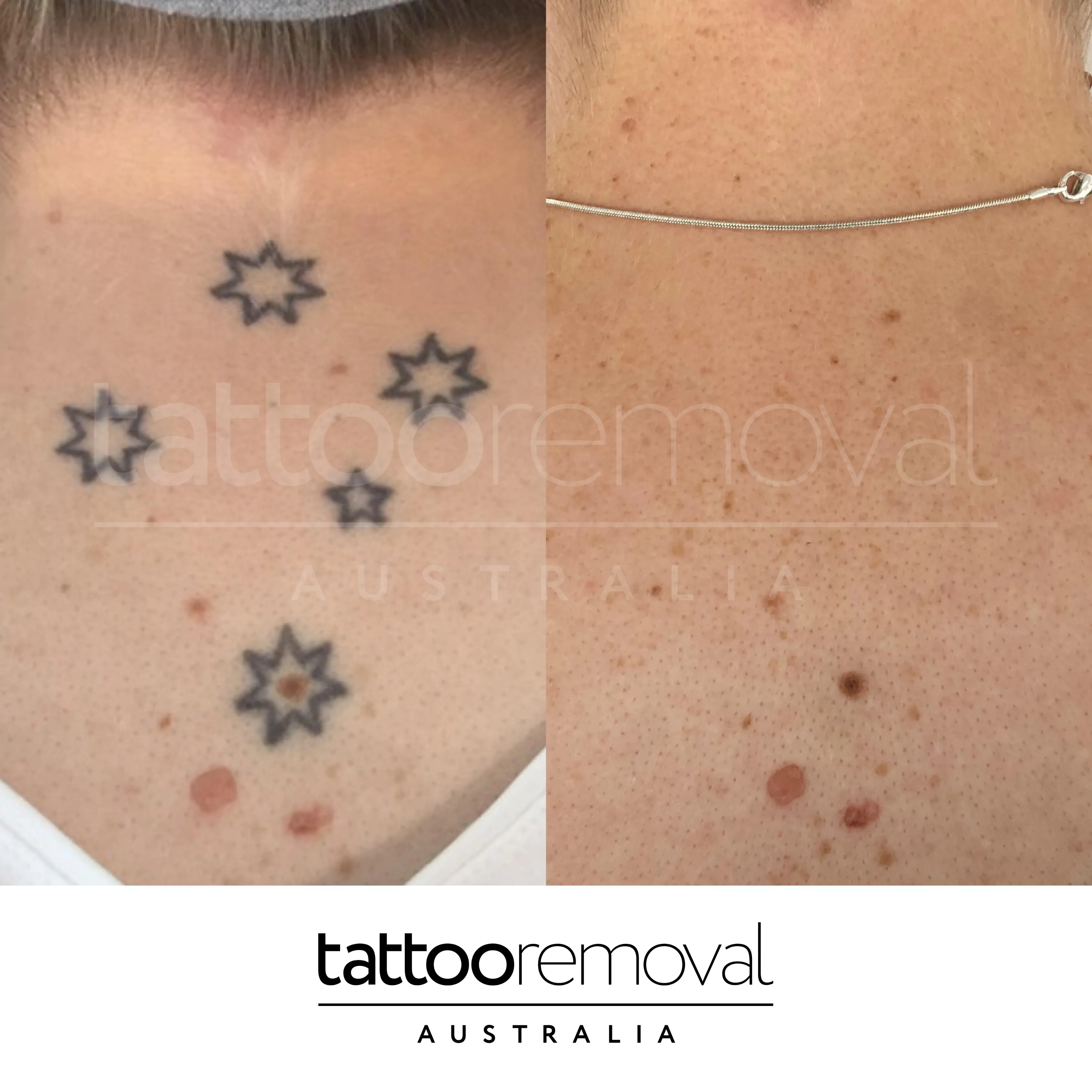 laser tattoo removal expert