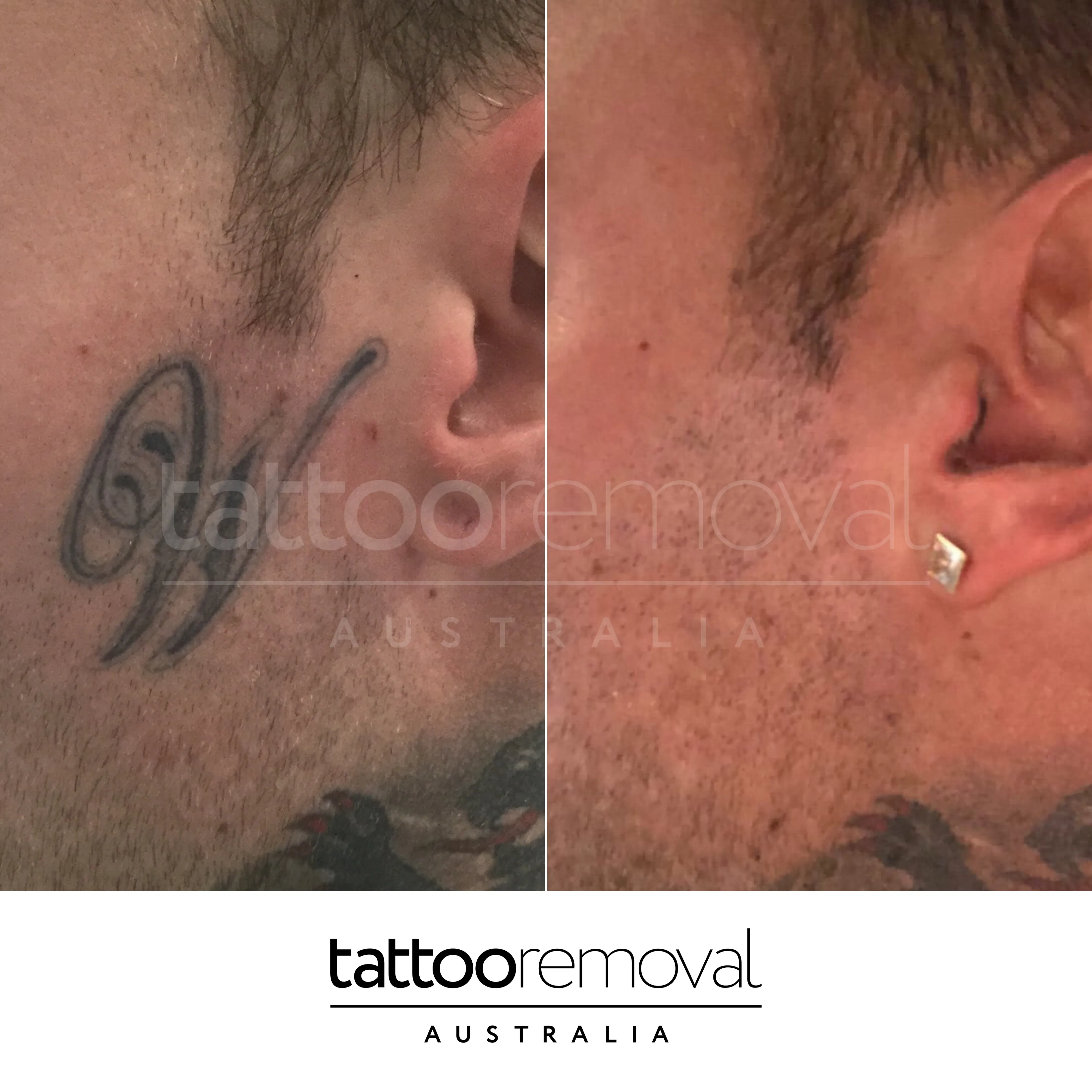 laser tattoo removal expert