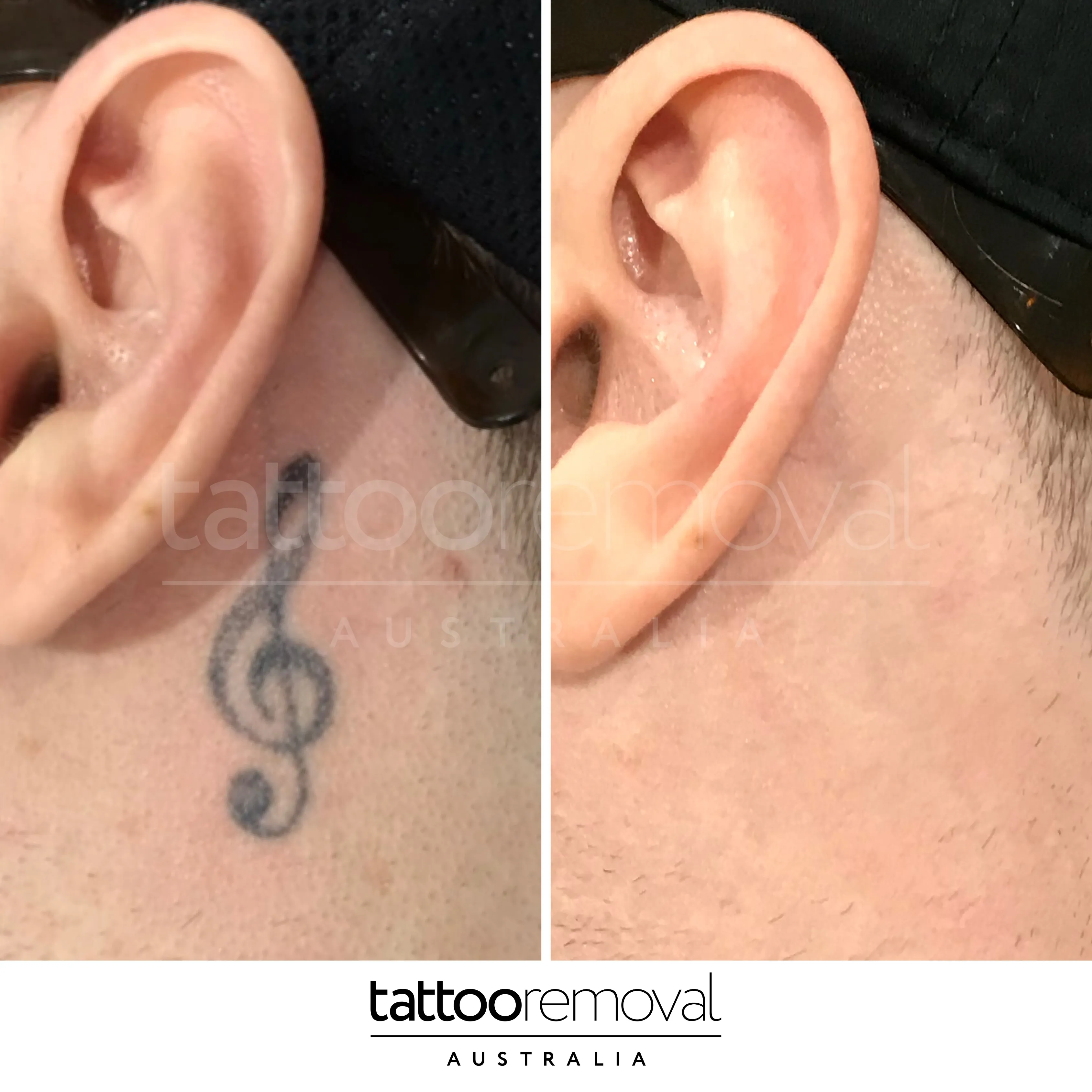 laser tattoo removal expert