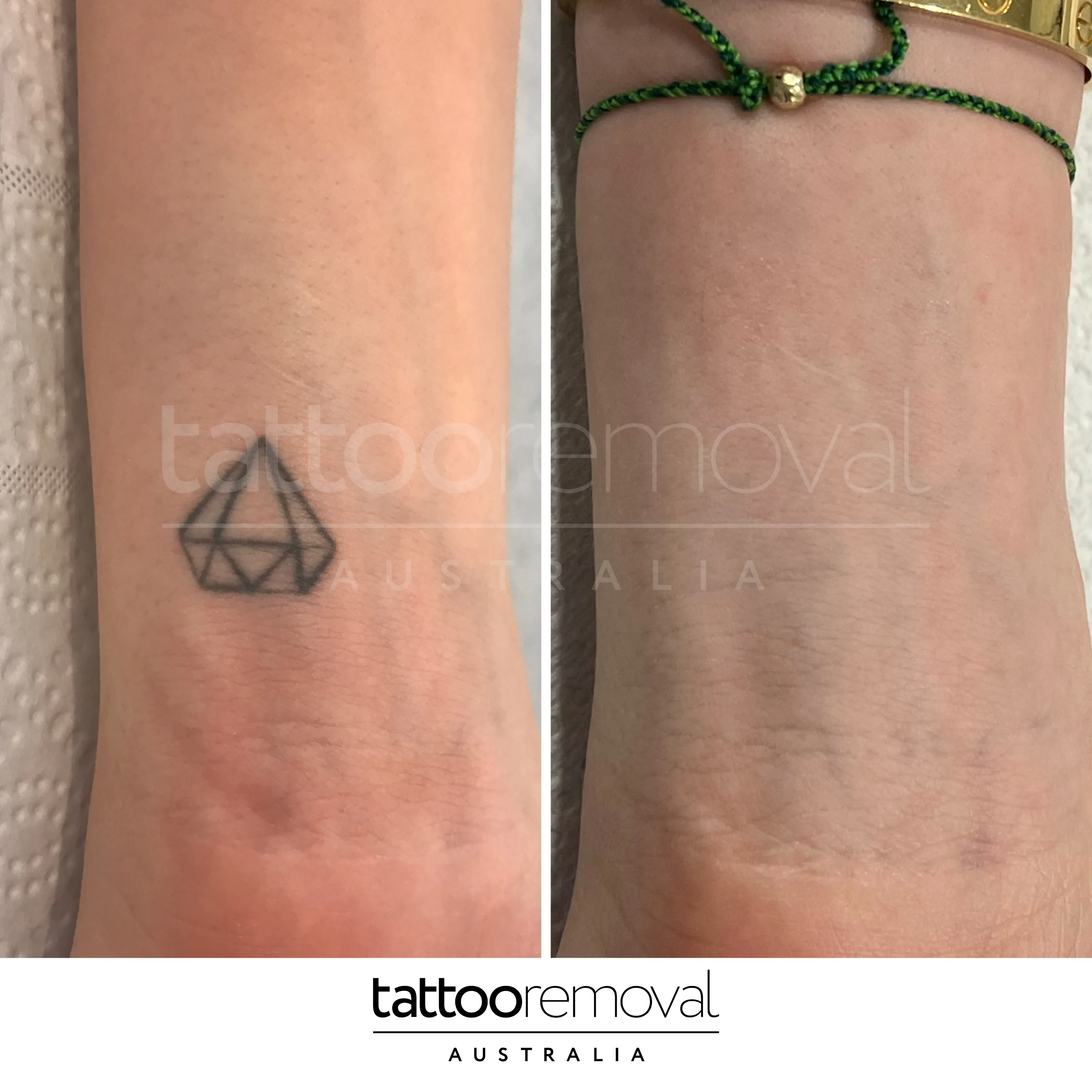 laser tattoo removal expert