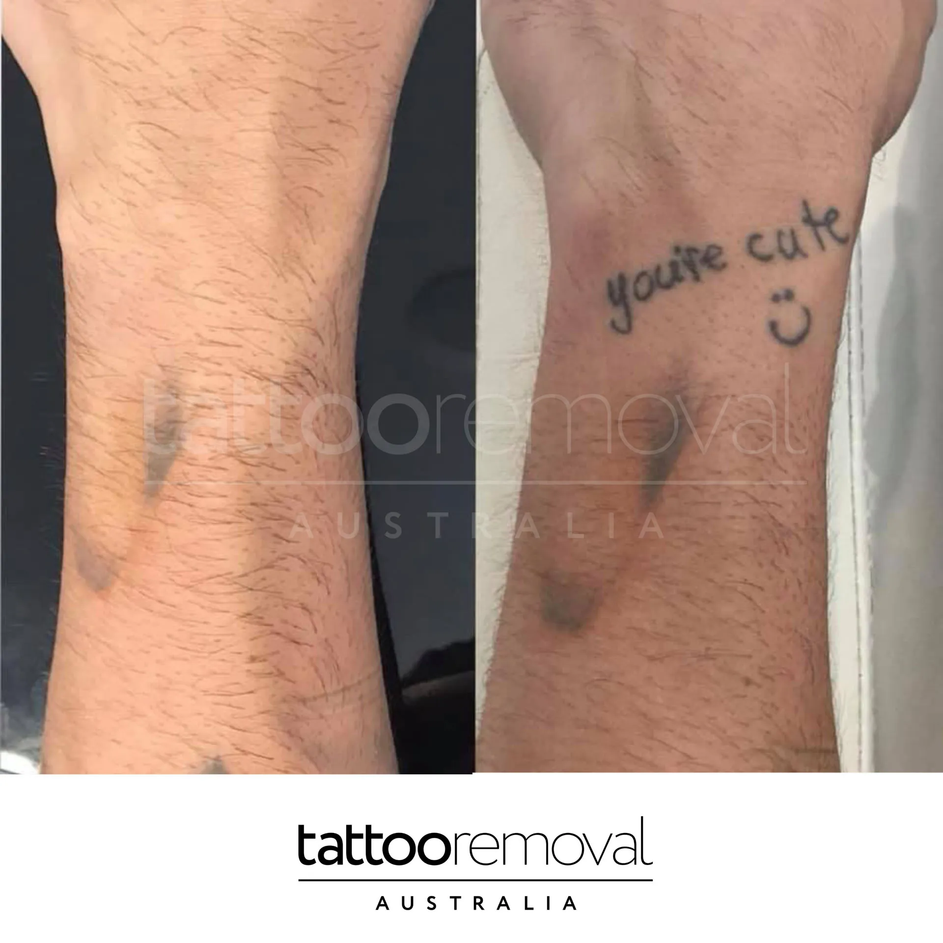 laser tattoo removal expert
