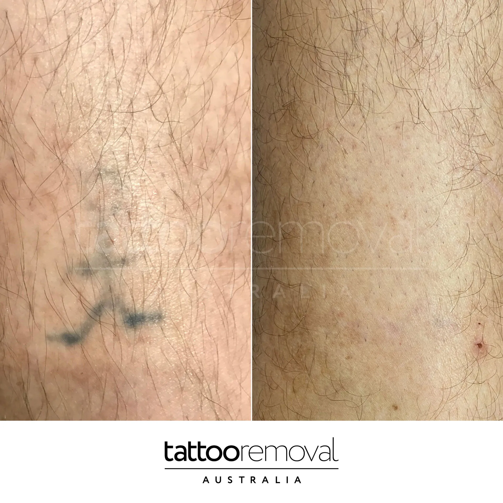 laser tattoo removal expert