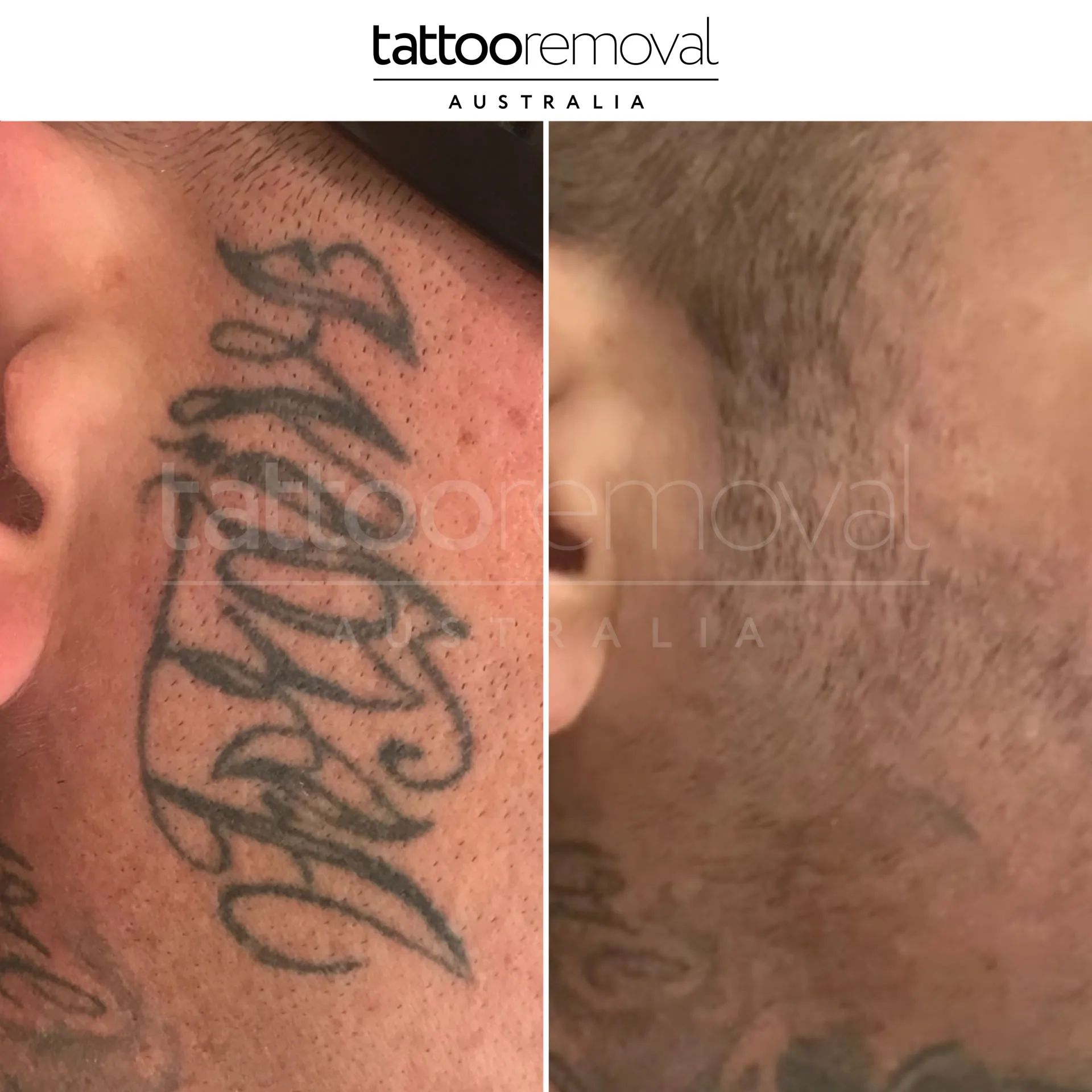 laser tattoo removal expert