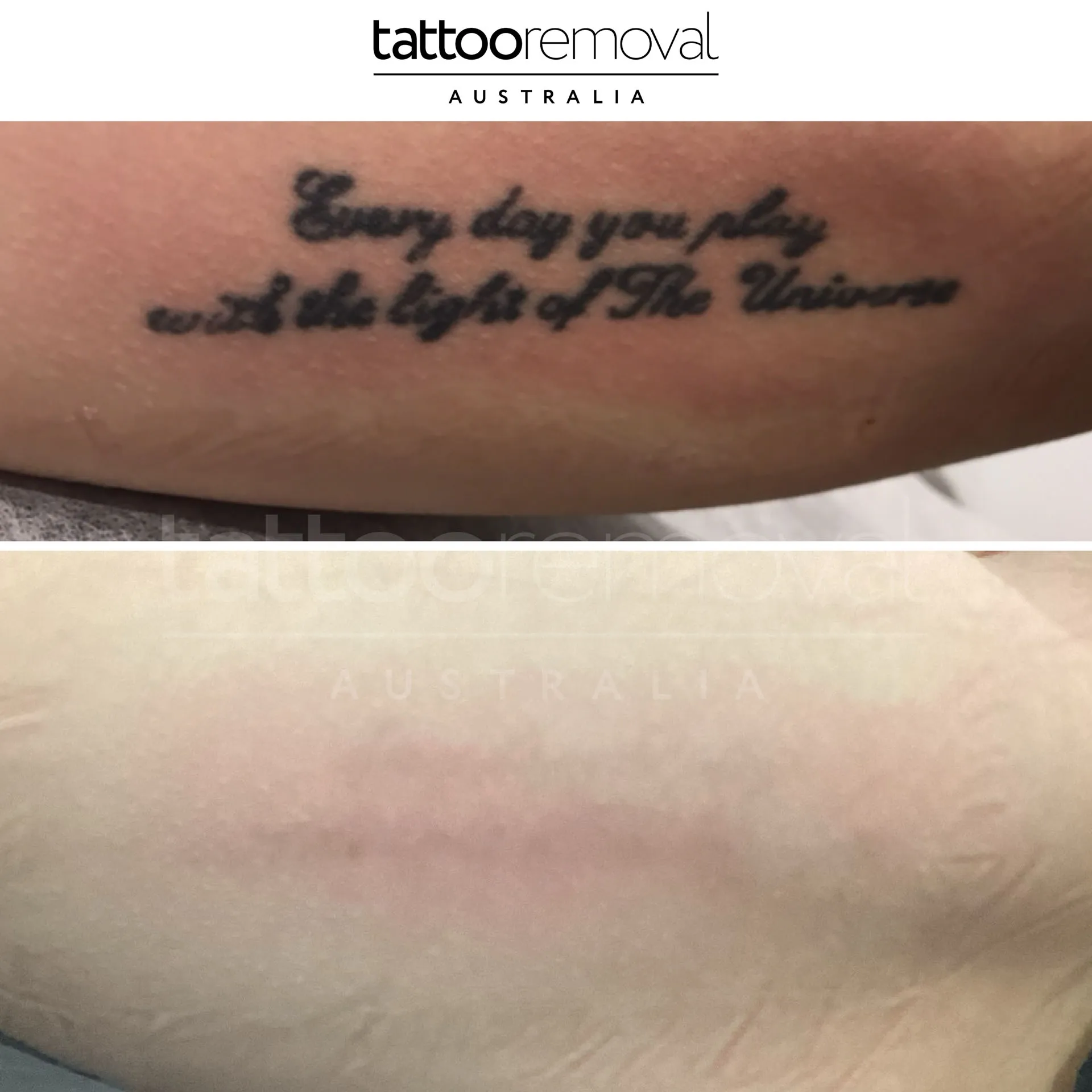 laser tattoo removal expert