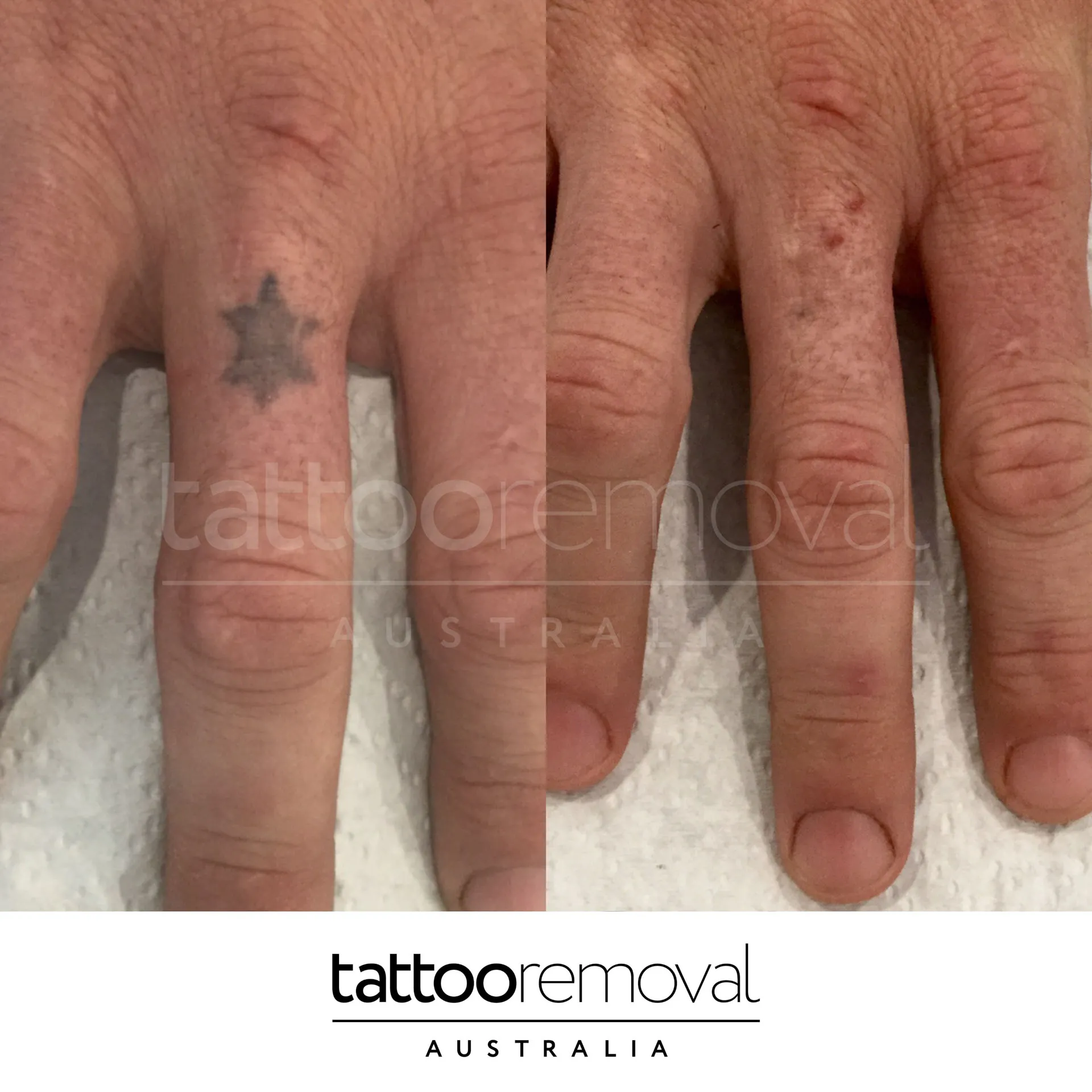 laser tattoo removal expert