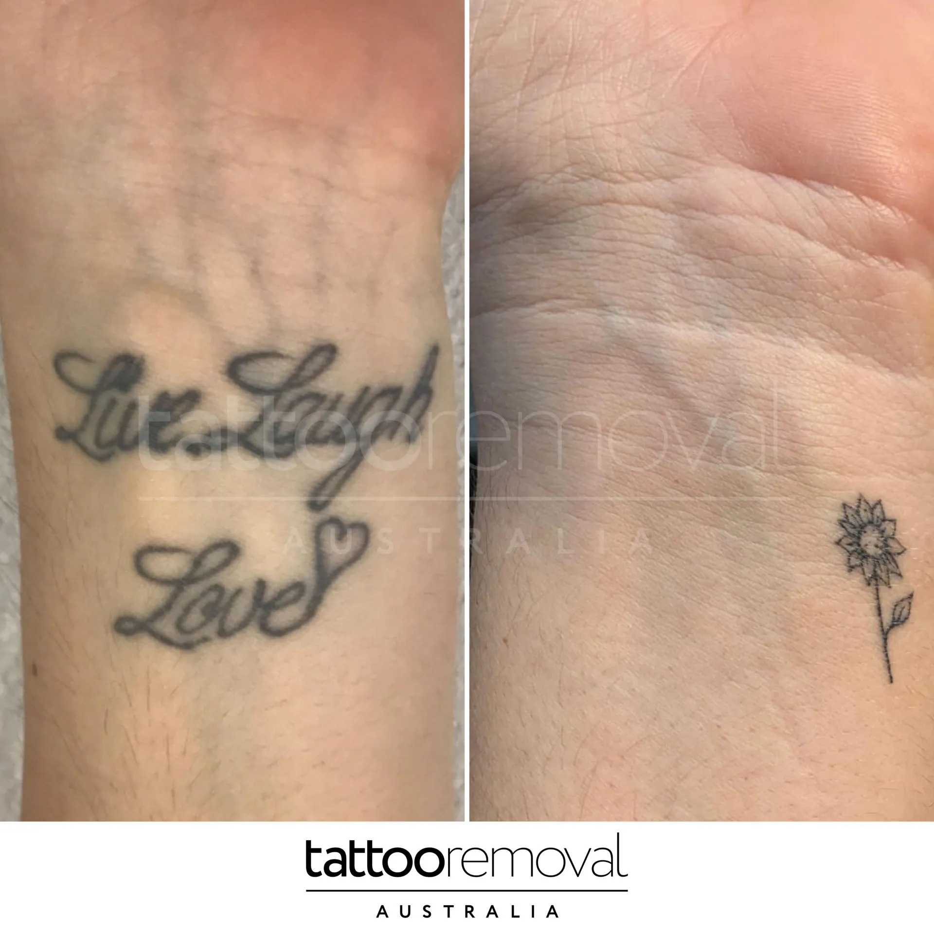 laser tattoo removal expert