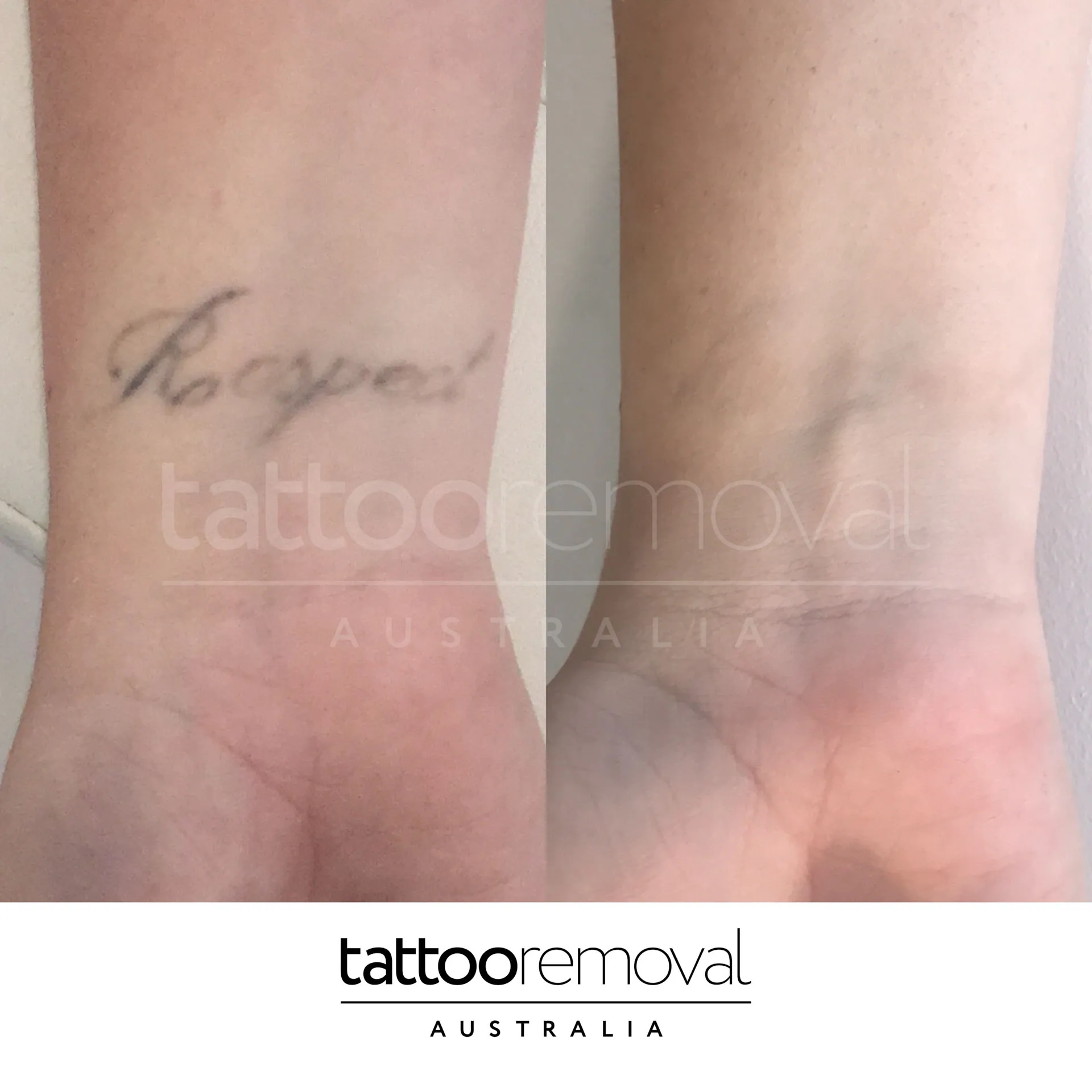 laser tattoo removal expert