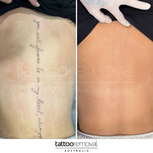 Tattoo Removal Gold Coast