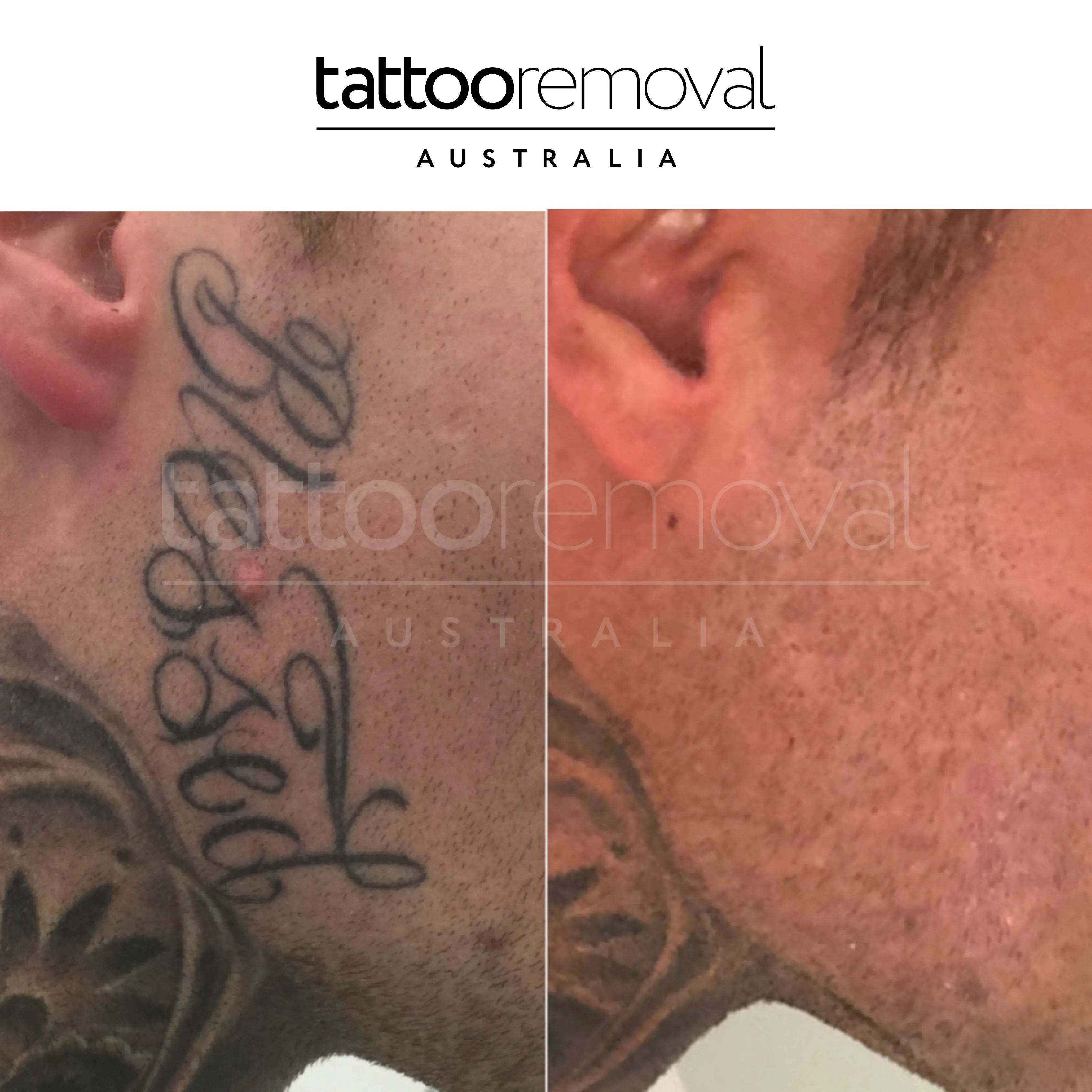 Tattoo Removal Gold Coast