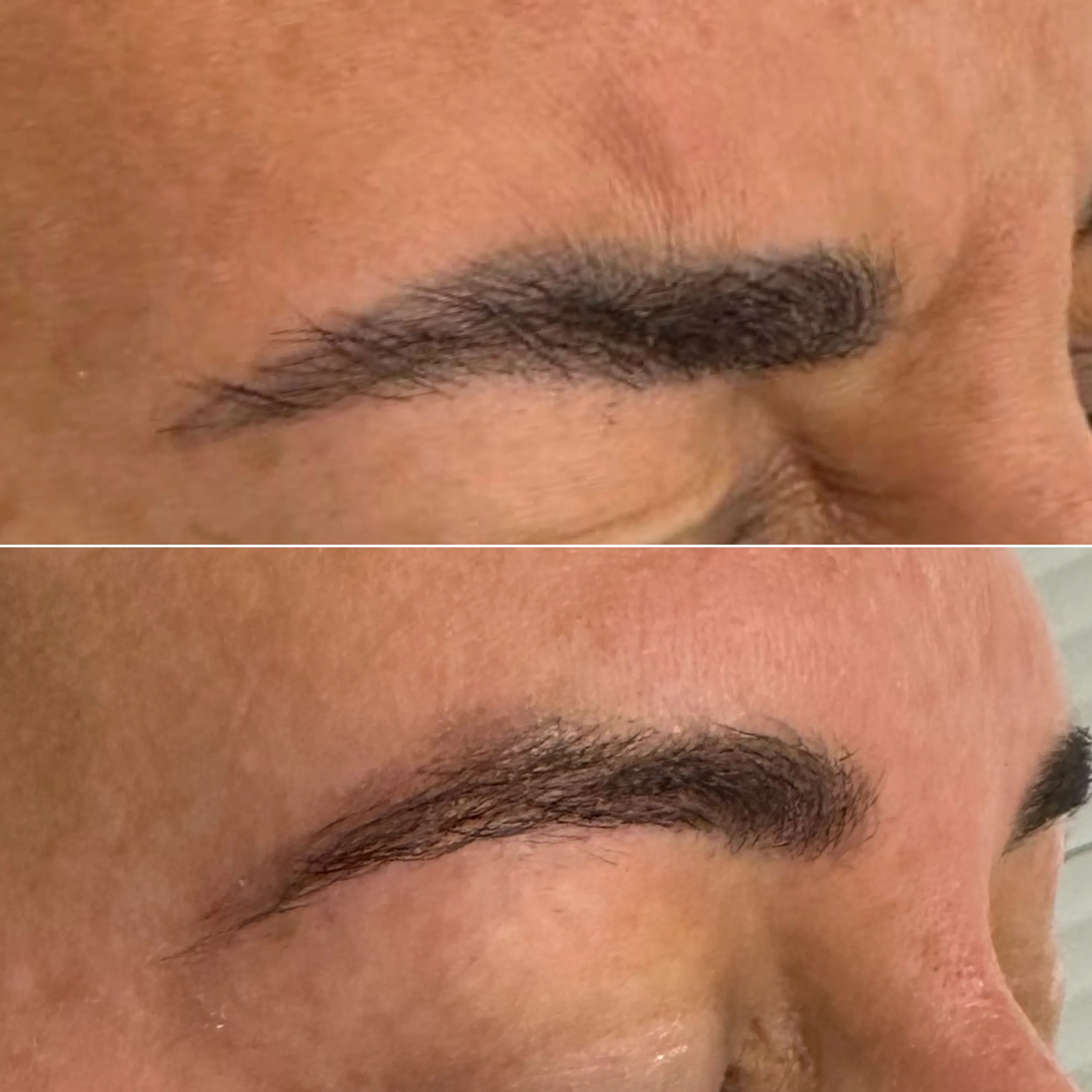 Cosmetic Tattoo Removal